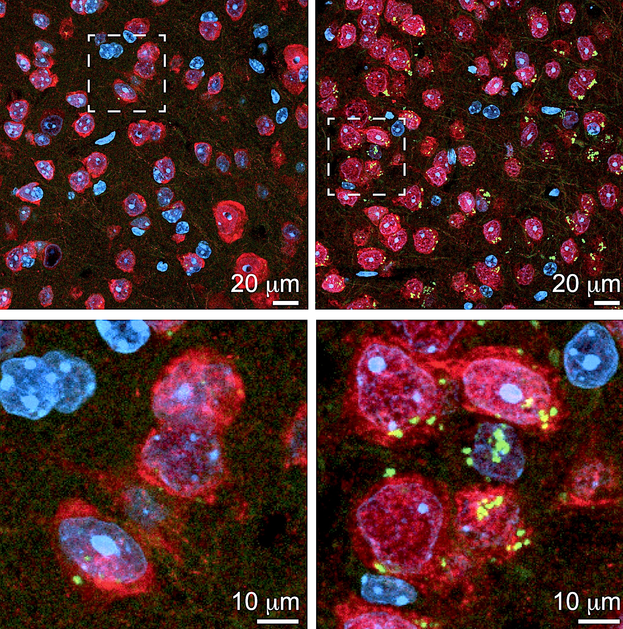 Four images with blobs of red, blue, and some green representing accumulating proteins in brain cells.
