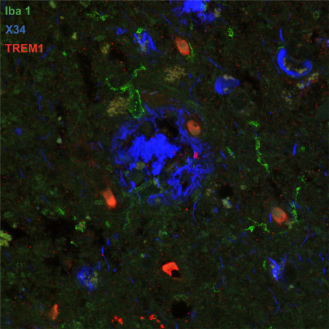 Image of post-mortem human frontal cortex showing TREM1 (red stain) in microglia and macrophages (Iba1; green stain) surrounding pathological amyloid buildup (X34; blue stain). The amount of TREM1 observed postmortem correlated with disease severity in Alzheimer’s patients.